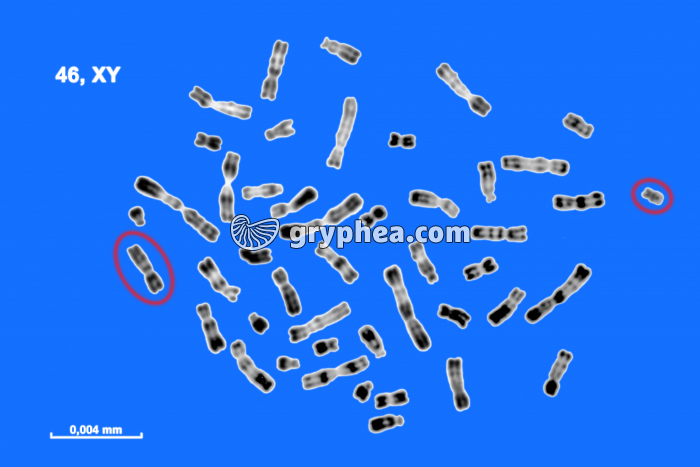 Caryotype non classé 46, XY - gryphea.org